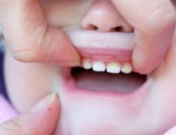 О желтом пятнышке у малыша 1,5 лет на зубе